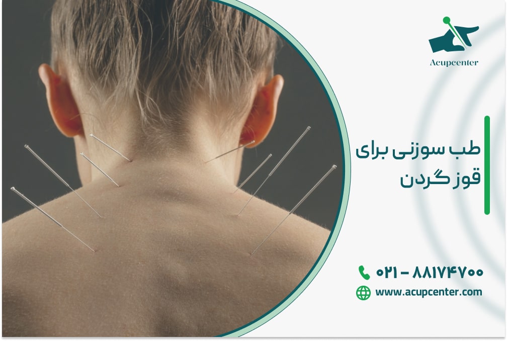 طب سوزنی برای قوز گردن