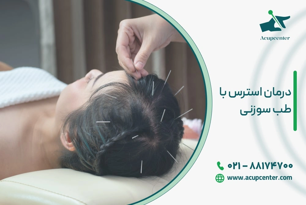 درمان استرس با طب سوزنی