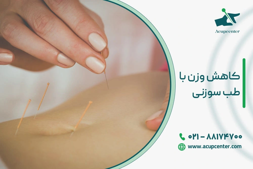 کاهش وزن با طب سوزنی