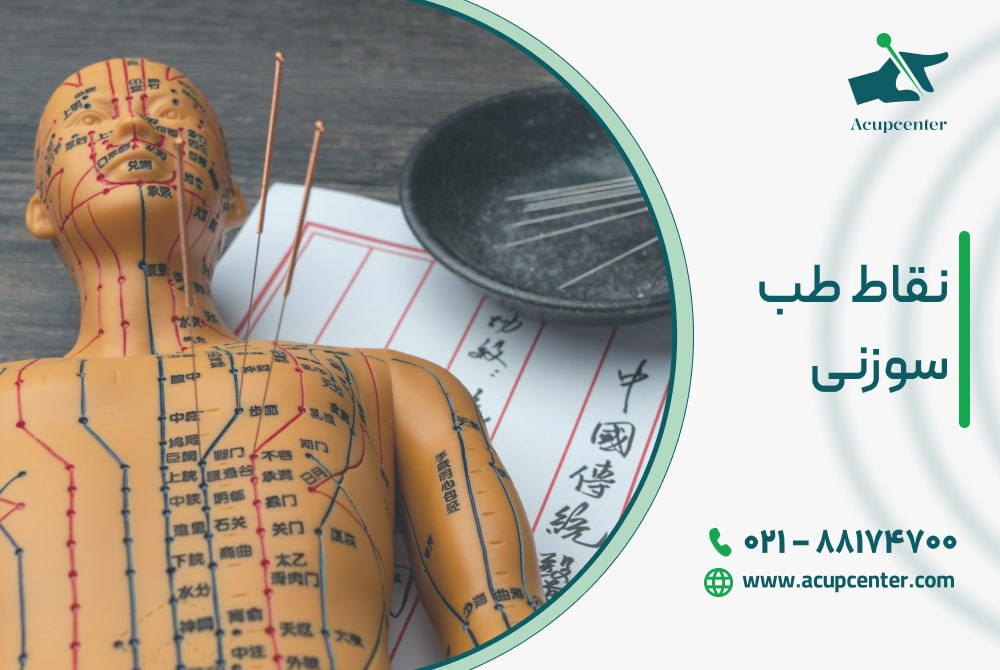 نقاط طب سوزنی