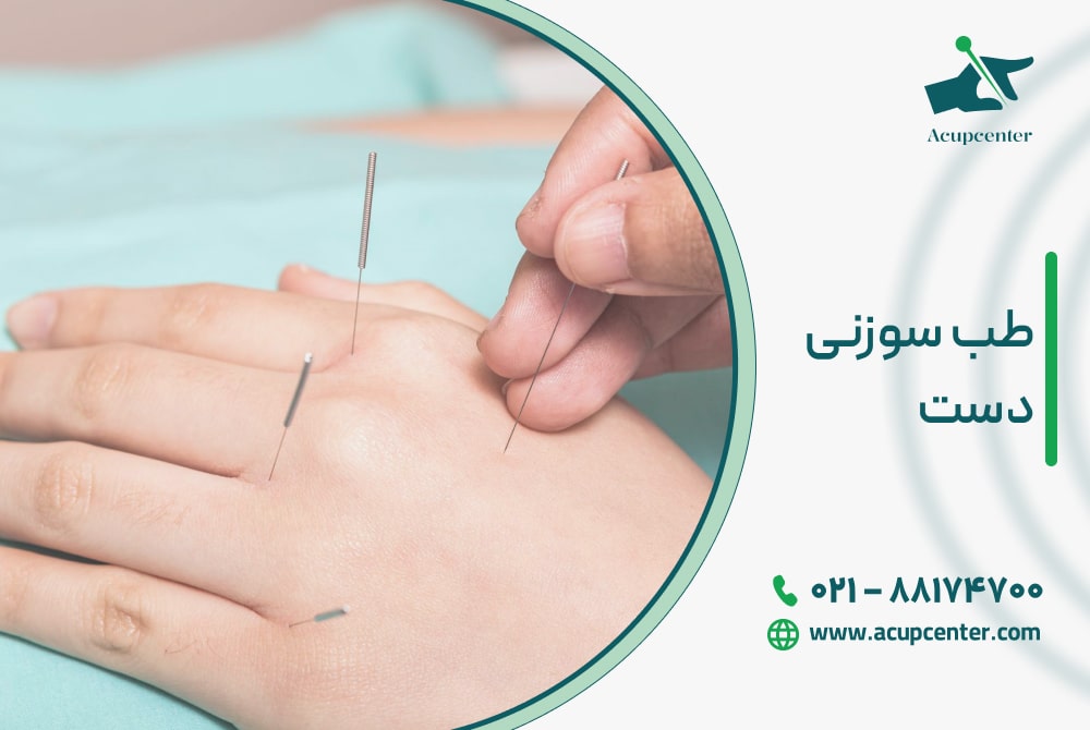 طب سوزنی دست