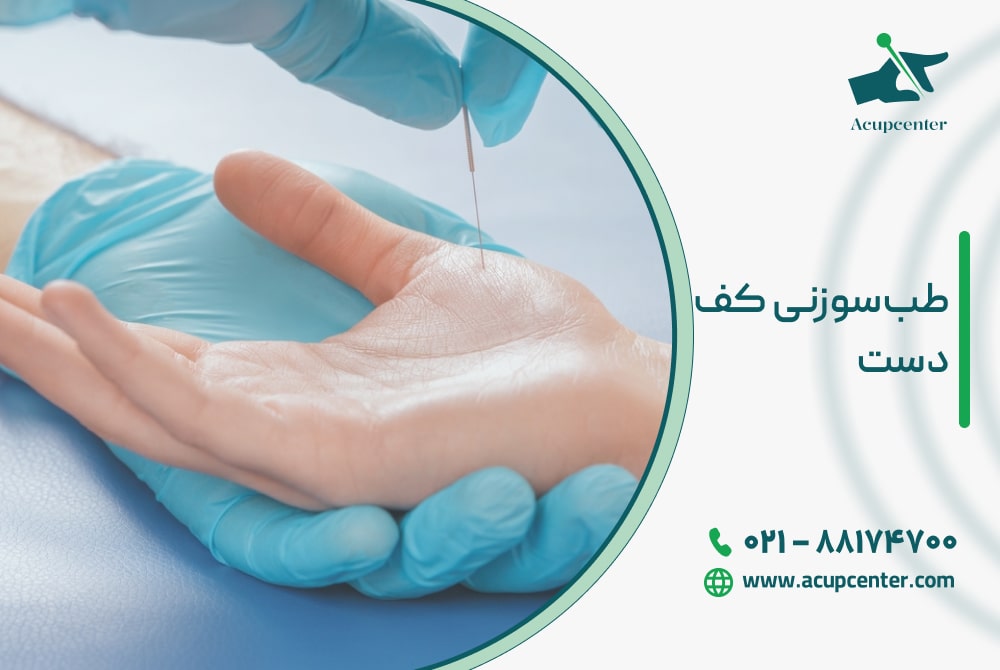 طب‌سوزنی کف دست