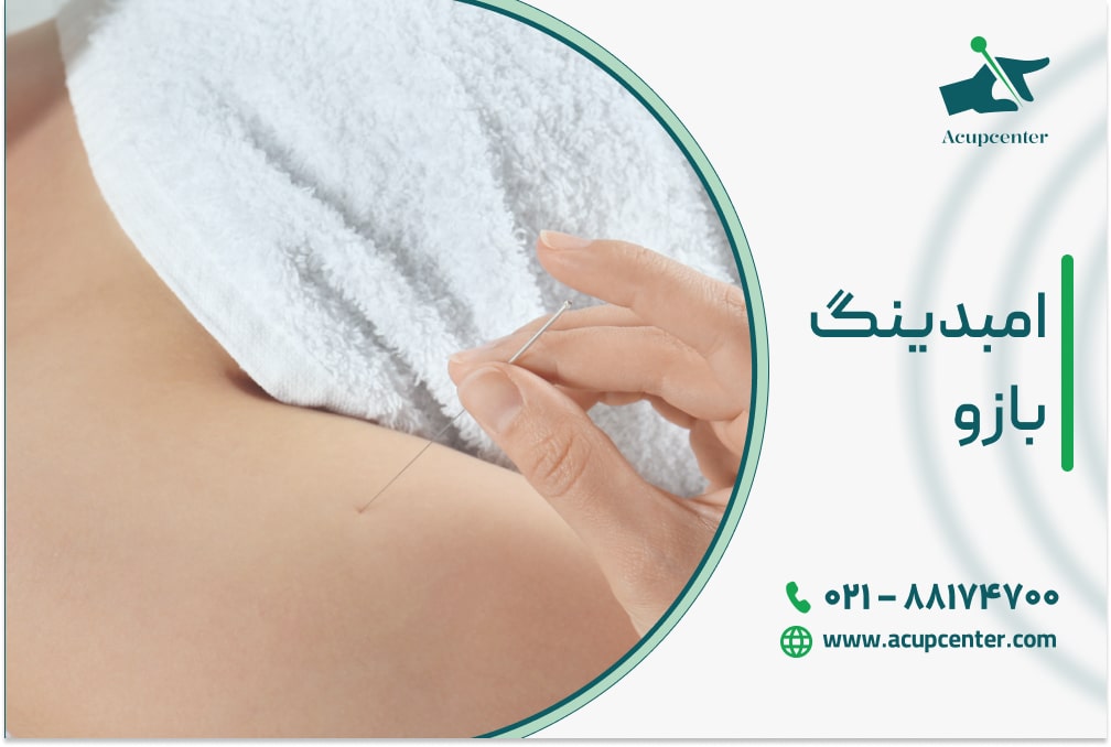 امبدینگ بازو