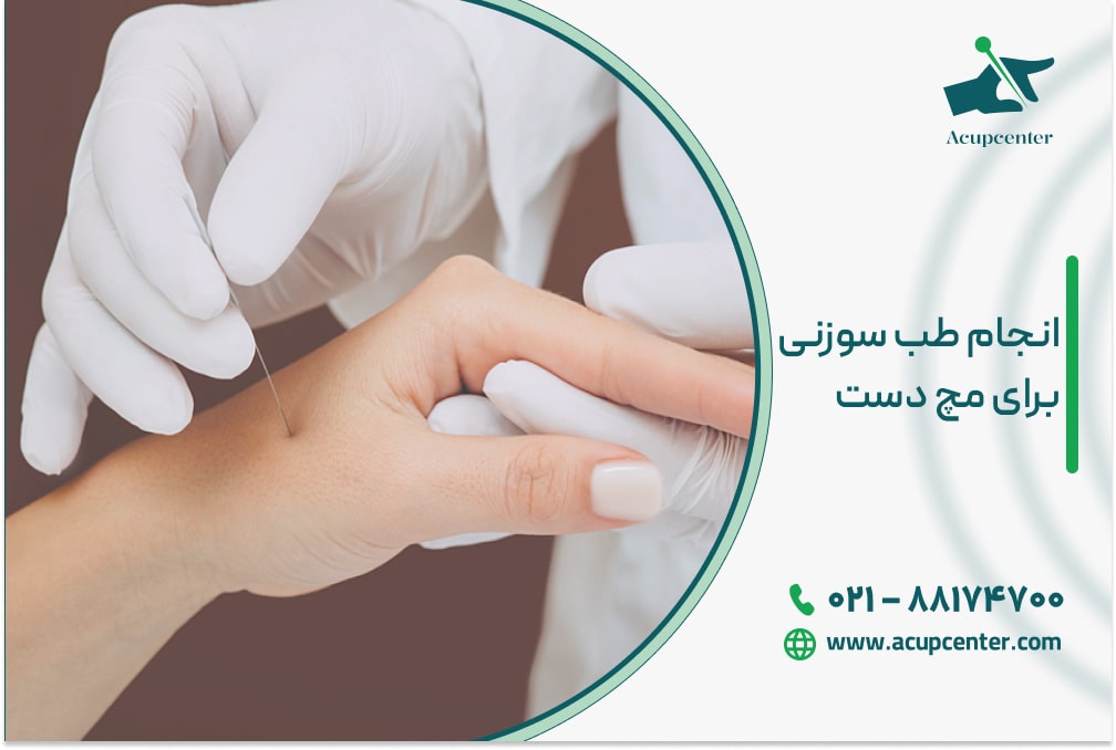 انجام طب سوزنی برای مچ دست