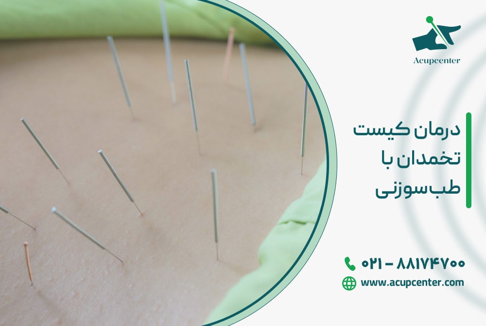 درمان کیست تخمدان با طب‌سوزنی