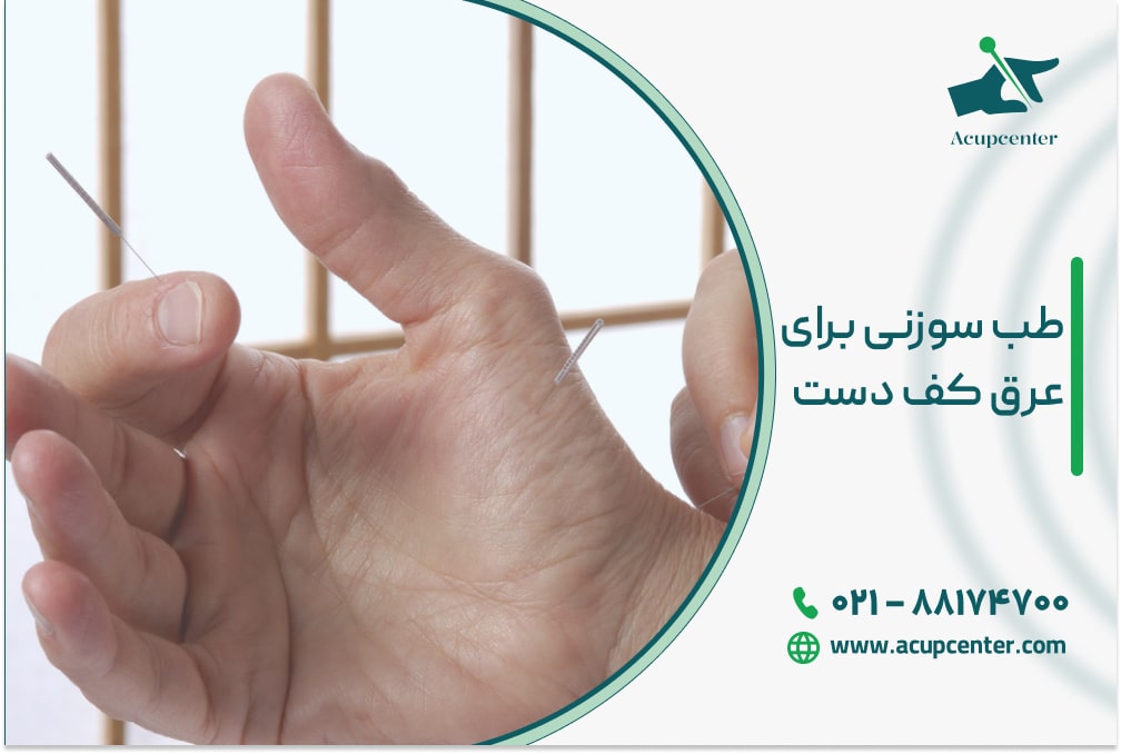 طب سوزنی برای عرق کف دست