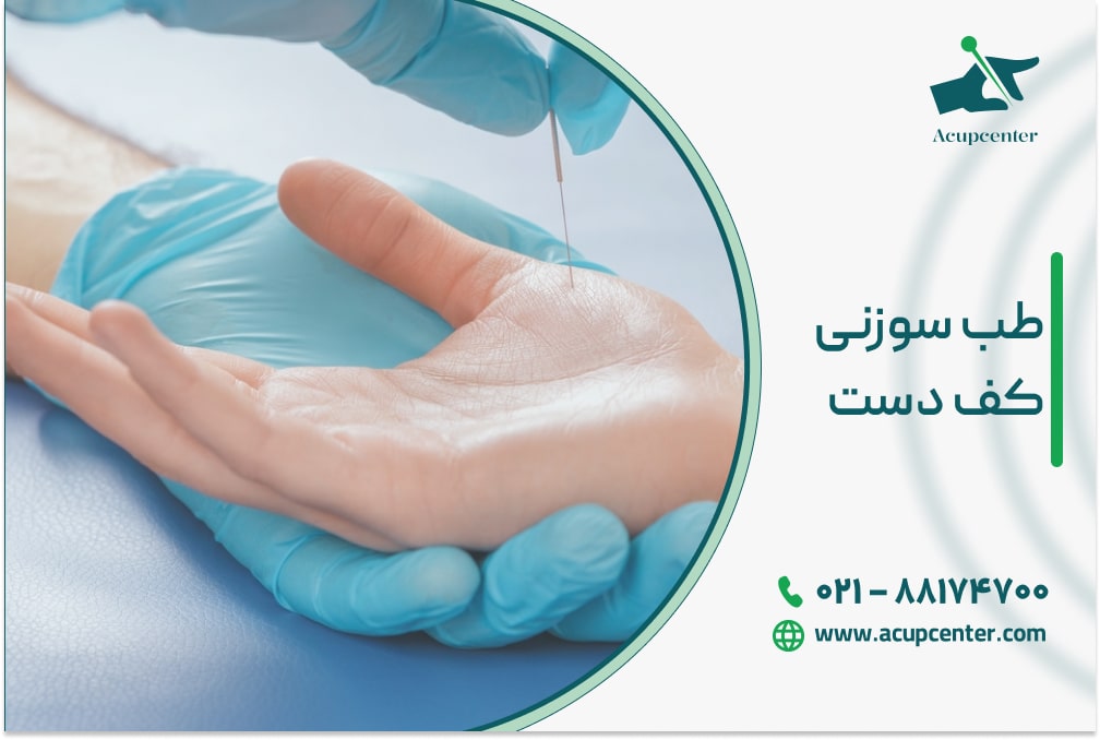 طب سوزنی کف دست