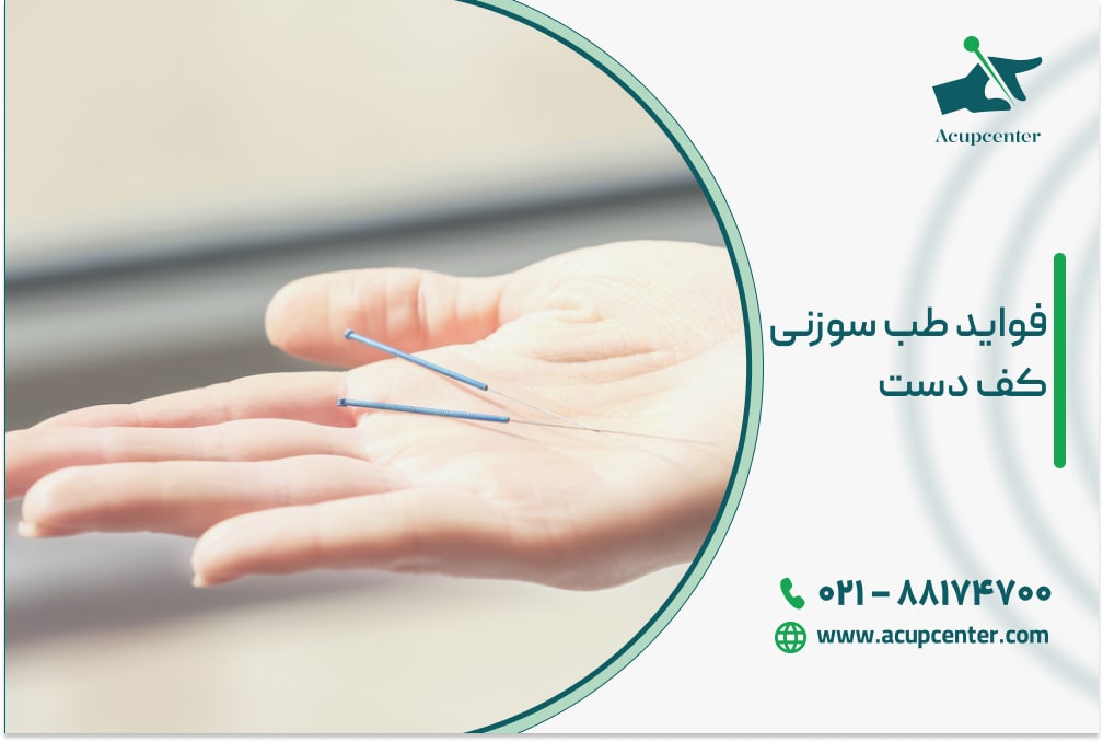 فواید طب سوزنی کف دست