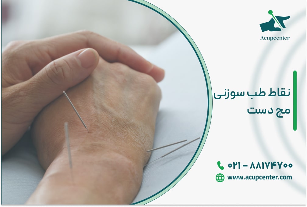 نقاط طب سوزنی مچ دست