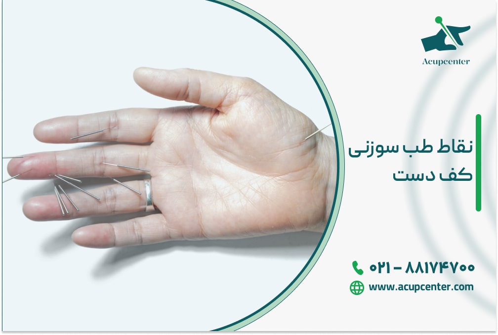 نقاط طب سوزنی کف دست