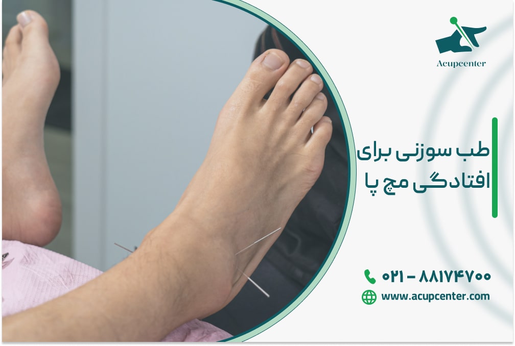افتادگی مچ پا با طب سوزنی