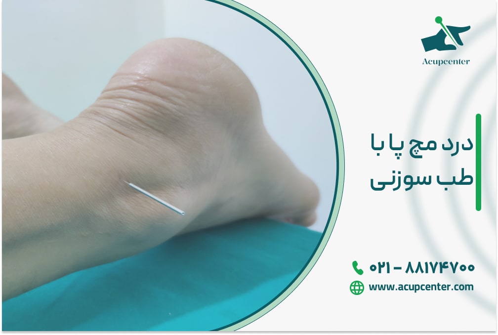 درد مچ پا با طب سوزنی