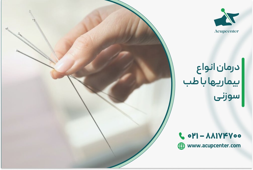 درمان انواع بیماریها با طب سوزنی