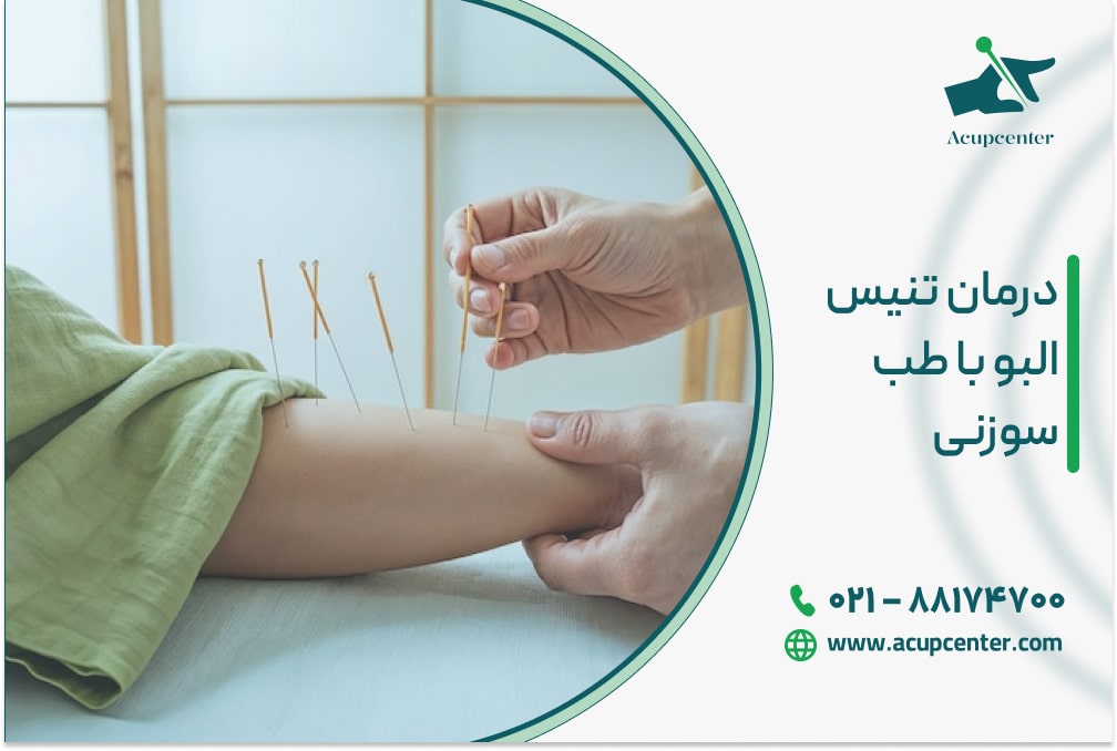 درمان تنیس البو با طب سوزنی