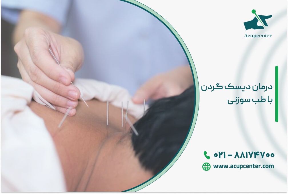 درمان دیسک گردن با طب سوزنی