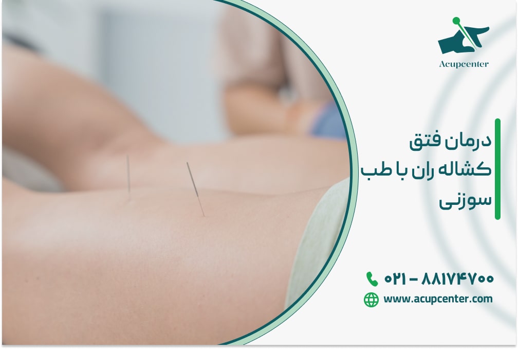 درمان فتق کشاله ران با طب سوزنی
