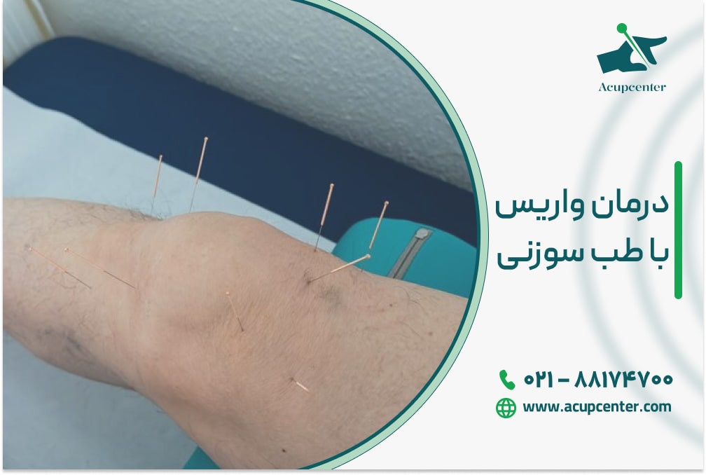 درمان واریس با طب سوزنی