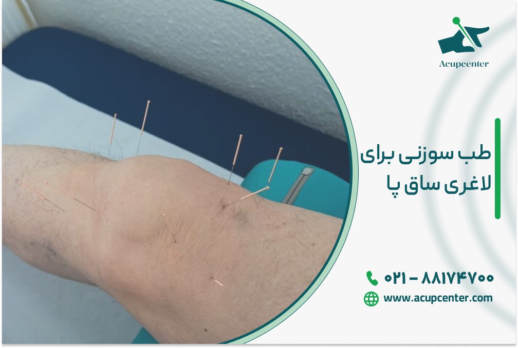 طب سوزنی برای لاغری ساق پا