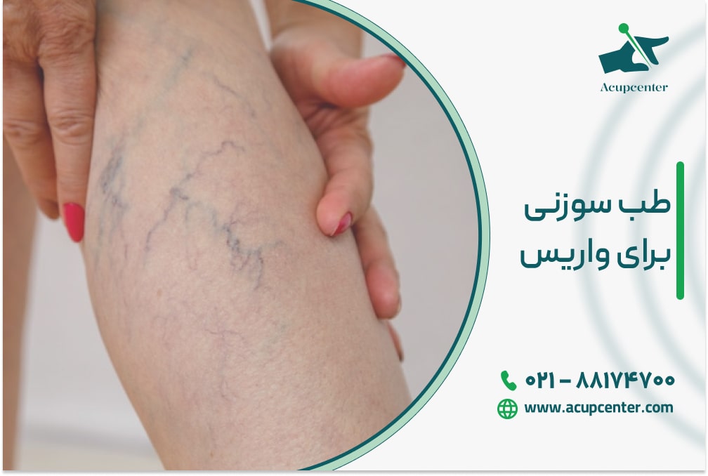 طب سوزنی برای واریس