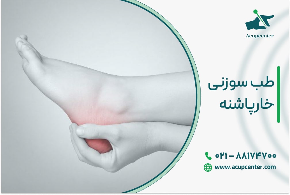 طب سوزنی خارپاشنه