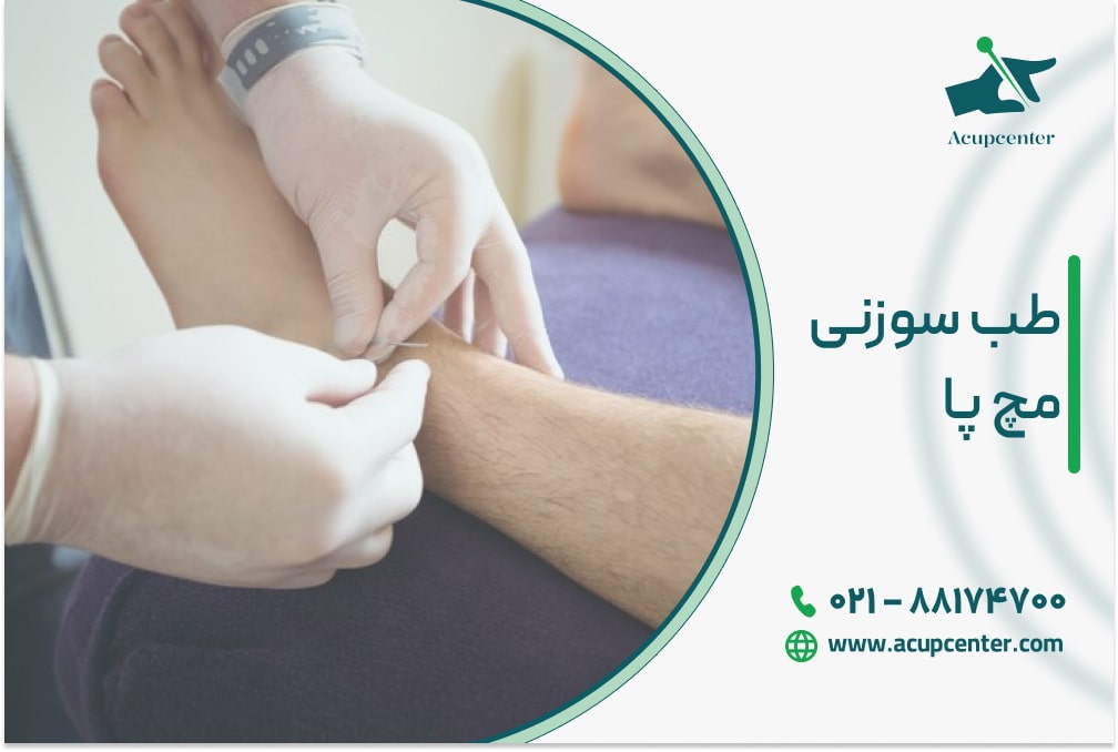 طب سوزنی مچ پا
