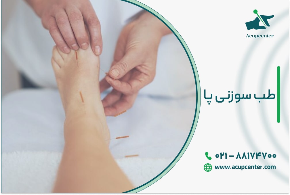 طب سوزنی پا
