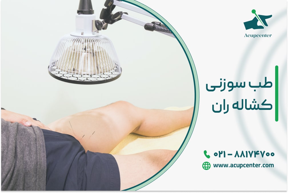 طب سوزنی کشاله ران