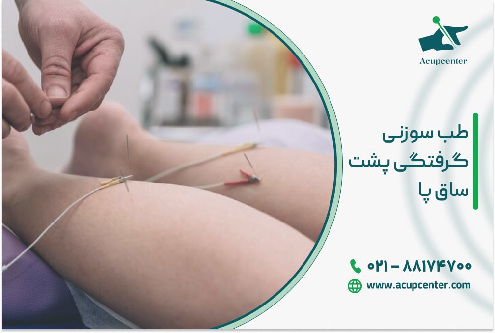 طب سوزنی گرفتگی پشت ساق پا